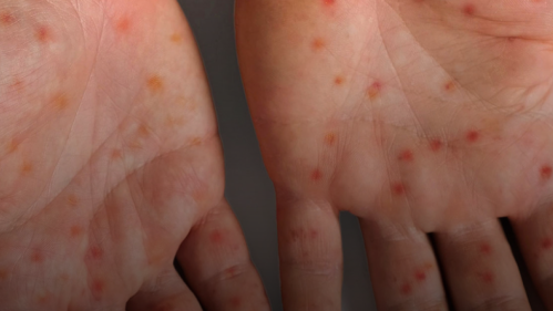 Hands with spots.